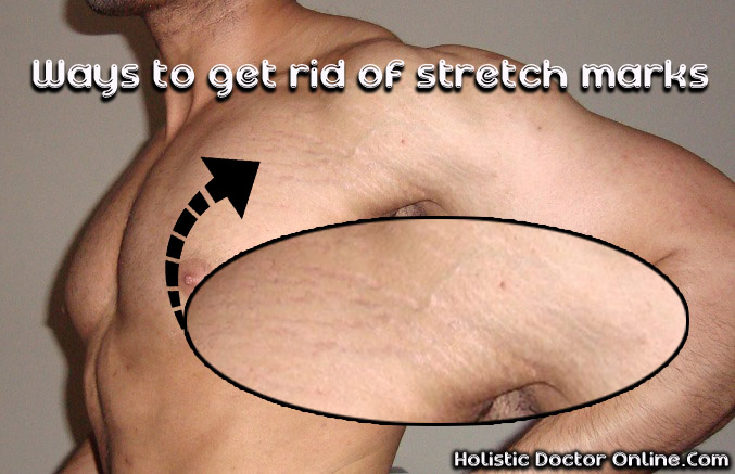 Stretch Marks: Why They Appear And How To Get Rid Of Them With