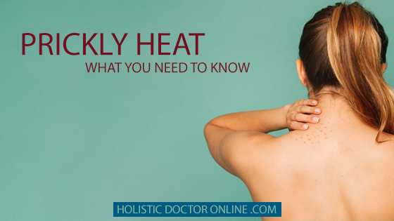 Prickly heat (heat rash)- Causes, home remedies and preventions