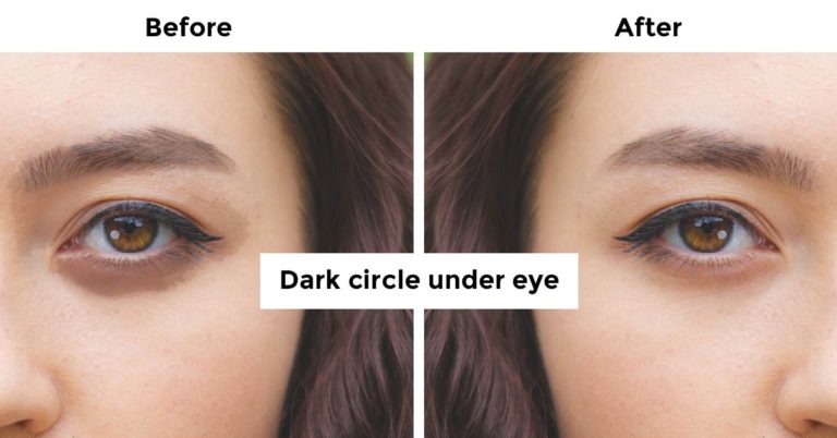 dark circle under eye