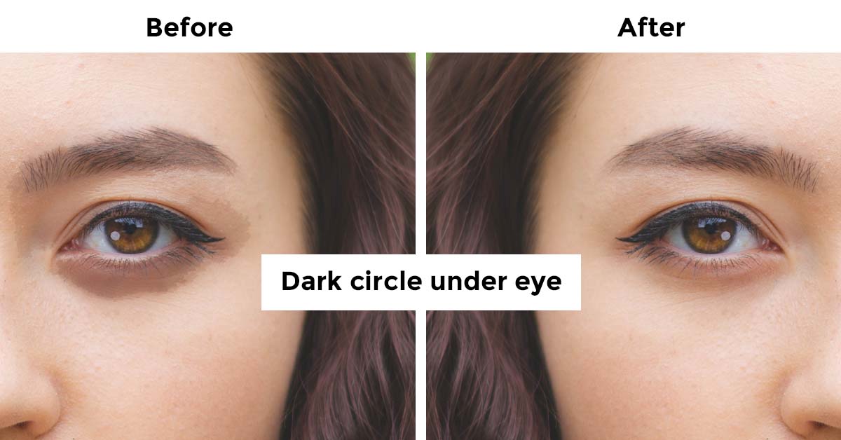How To Remove Dark Circle Under The Eye Advanced Holistic Ways