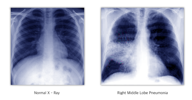 Symptoms, causes and treatment for pneumonia