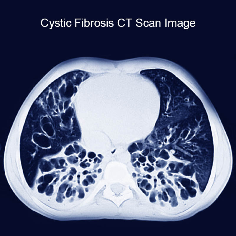 Cystic Fibrosis CT Scan Image