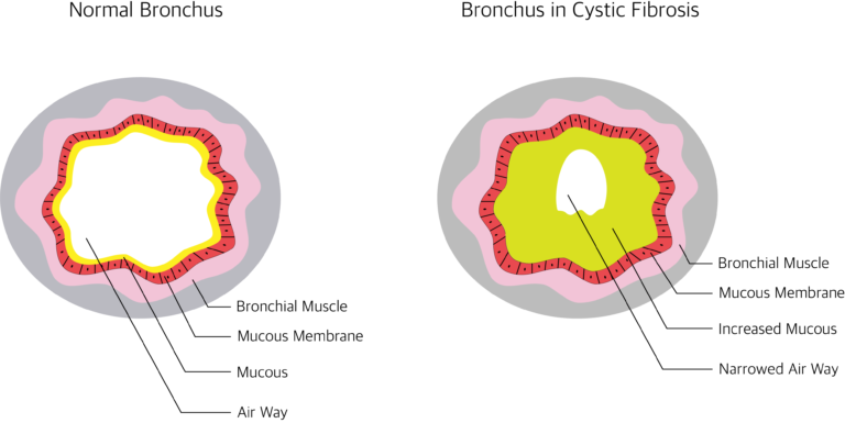 Cystic Fibrosis