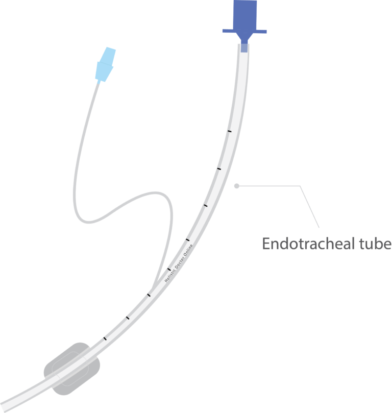 What is Intubation and why it is done? | Holistic Doctor Online