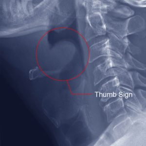 Causes, Signs, Symptoms and Treatment for Epiglottitis