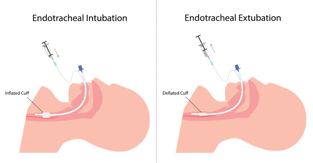 Endotracheal Intubation and Endotracheal Extubation