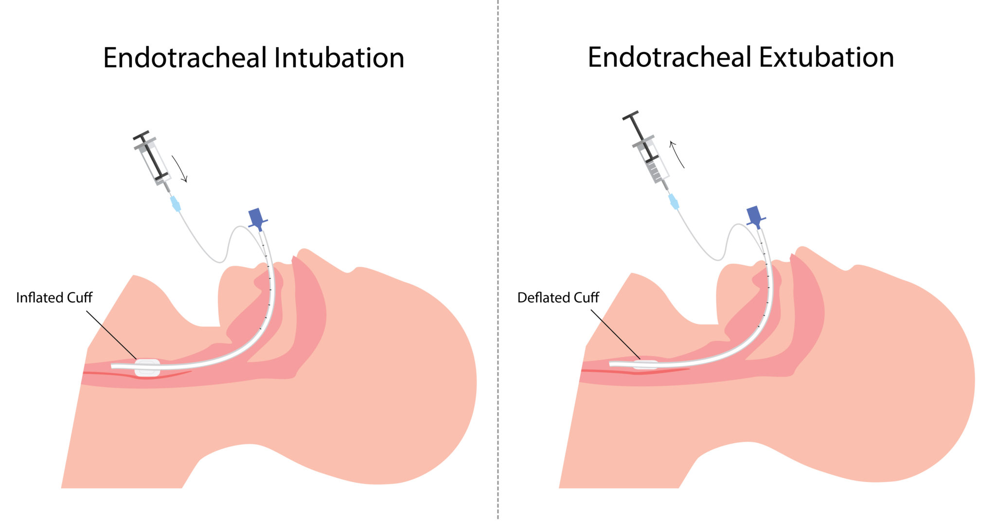 Endotracheal Tube Vs Tracheostomy Tube