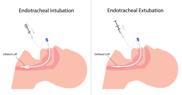 Tracheal Extubation