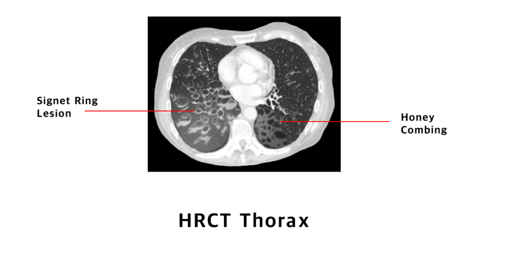 Obstructive Pulmonary Diseases of the Lower Airways…It's not all Emphysema!  Karin and Jason Kuhl 4/14/ ppt video online download