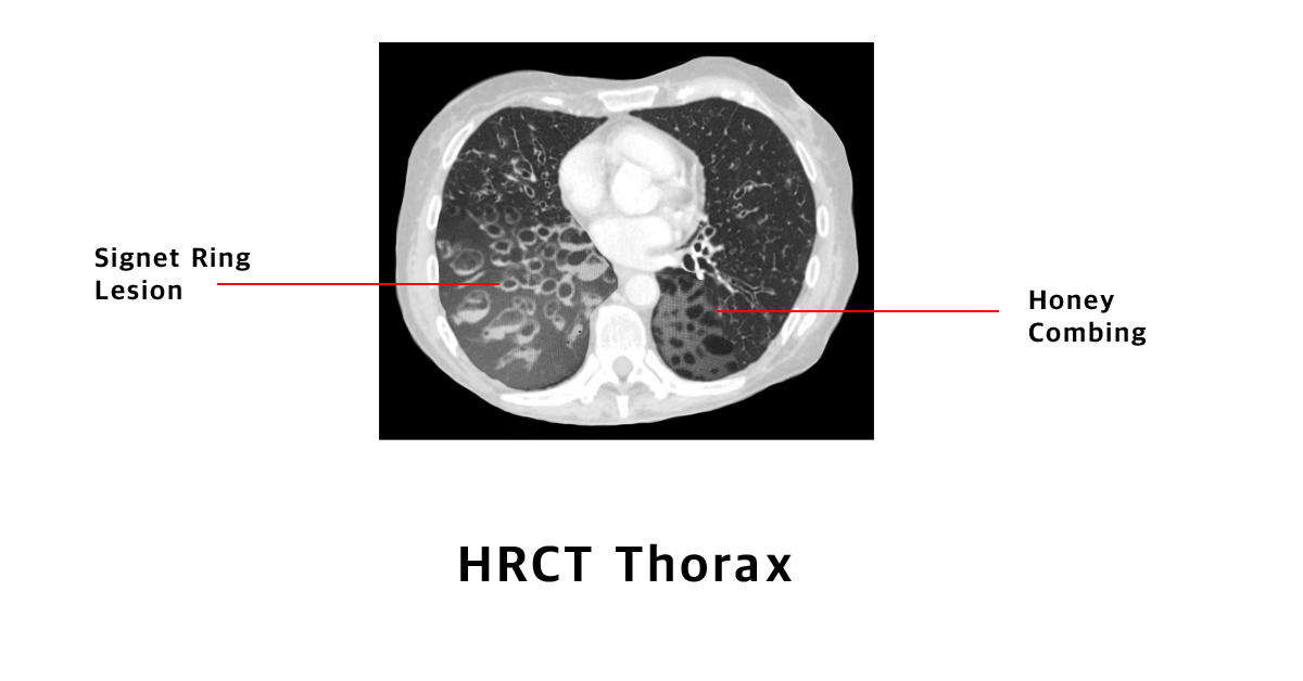 Causes, Symptoms, Diagnosis And Treatment Of Bronchiectasis | Holistic ...