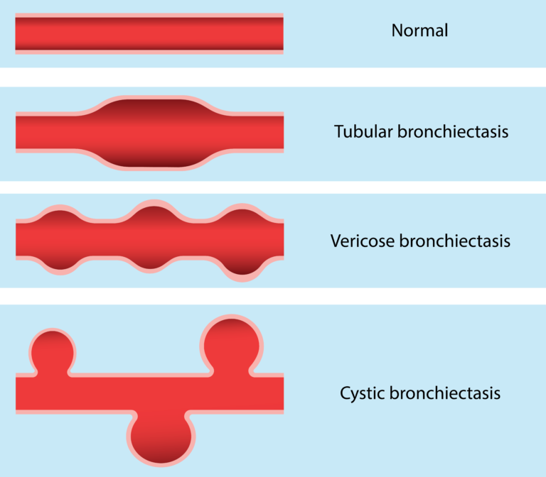 Causes, Symptoms, Diagnosis and treatment of bronchiectasis