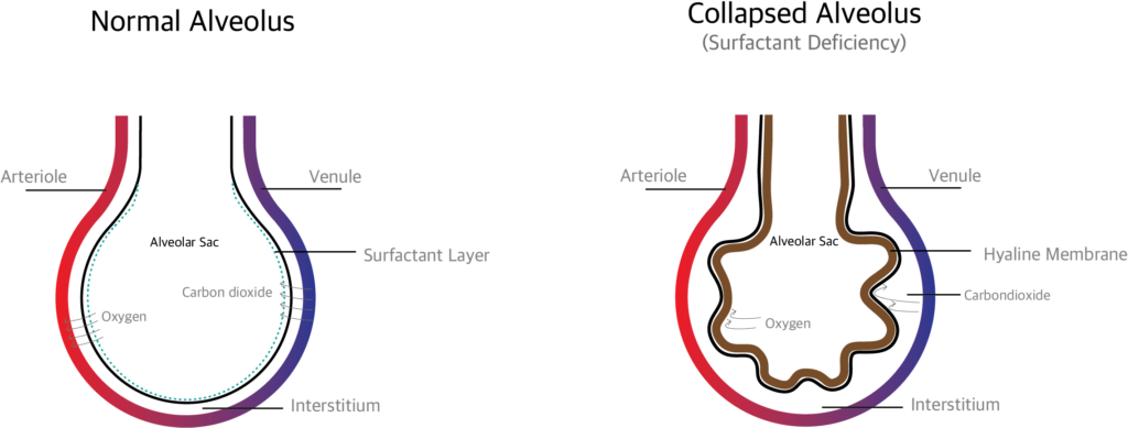 respiratory-distress-syndrome-rds-in-neonates