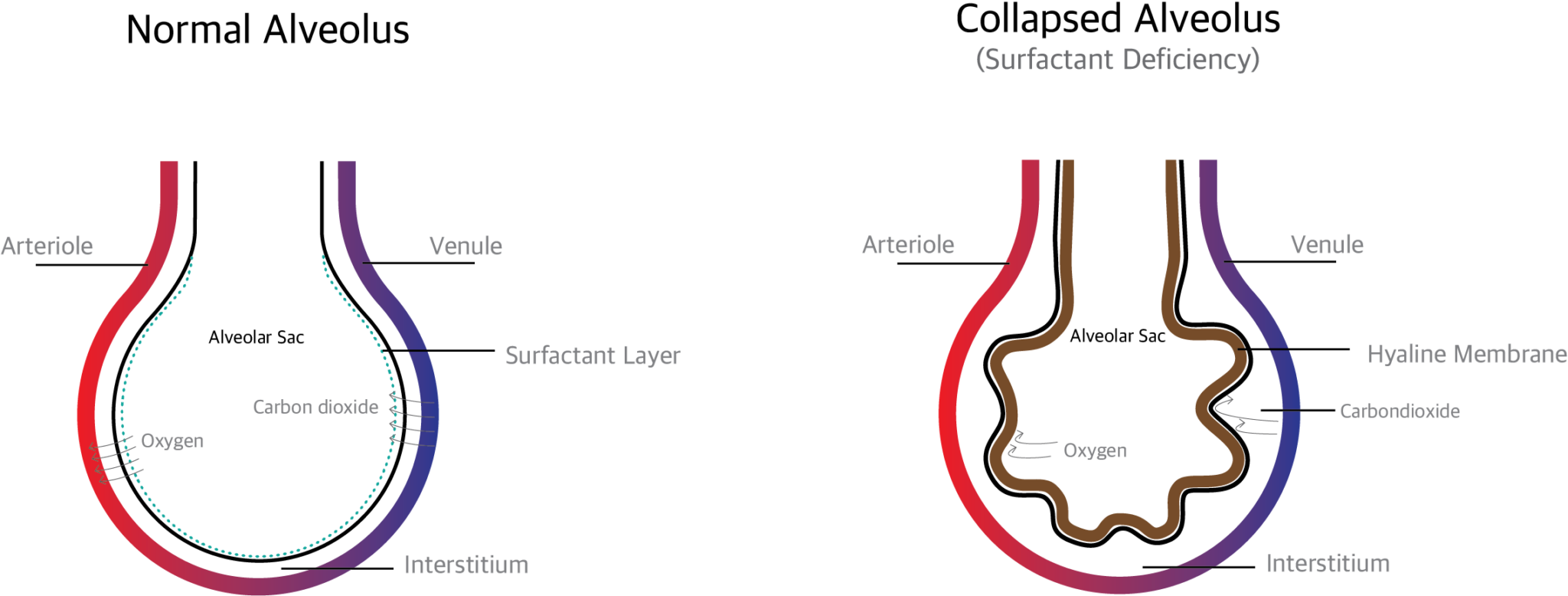 Respiratory Distress Syndrome (RDS) in Neonates