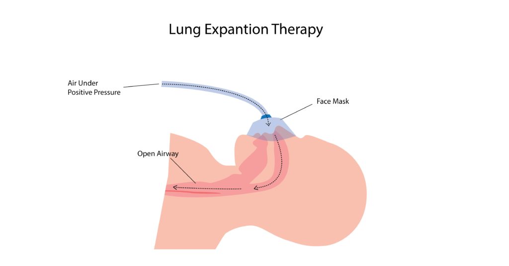 Lung Expantion Therapy