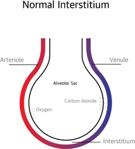 Pulmonary Interstitium and Interstitial lung disease | Holistic Doctor ...