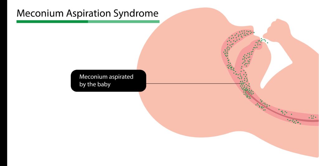 Meconium Aspiration Syndrome. Meconium aspirated by the baby image explained