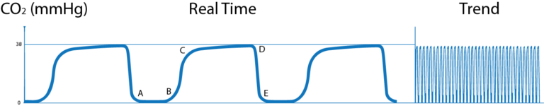 What is Capnography?, Indications, Uses and Interpretations. | Holistic ...