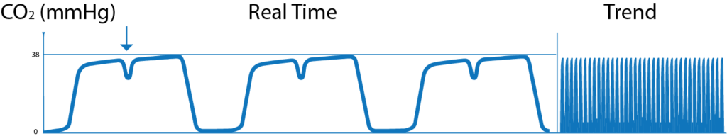 Cleft in wave Diagram