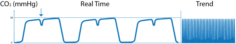 What is Capnography?, Indications, Uses and Interpretations. | Holistic ...