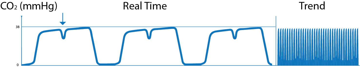 What is Capnography?, Indications, Uses and Interpretations. | Holistic ...