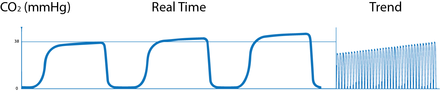 What is Capnography?, Indications, Uses and Interpretations. | Holistic ...