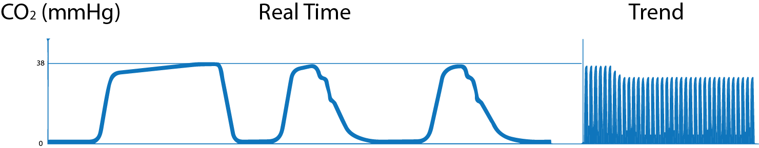 What is Capnography?, Indications, Uses and Interpretations. | Holistic ...