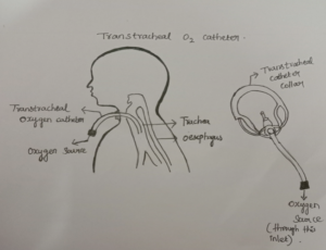 Transtracheal oxygen catheter